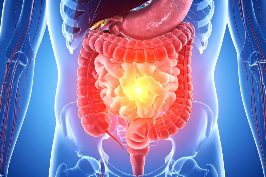 Il microbiota, nutrito con una dieta di bassa qualità, si altera verso una condizione disbiotica che può portare all’erosione del muco, favorendo condizioni come la colite, che è più tipici di infiammazione intestinale in cui accade questo fenomeno, dove i microrganismi superano tutte le barriere di difesa.