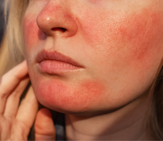 Danni da raggi UV e filtri solari: cosa deve sapere il farmacista fotoprotezione e counseling del farmacista