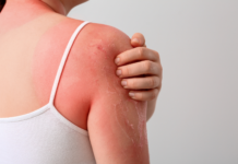 Fotoprotezione dall’interno: il ruolo di nutraceutici e fitoterapici nel danno da UV Fotoprotezione dall’interno