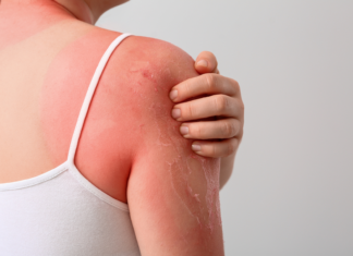 Fotoprotezione dall’interno: il ruolo di nutraceutici e fitoterapici nel danno da UV Fotoprotezione dall’interno