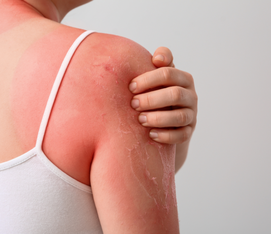 Fotoprotezione dall’interno: il ruolo di nutraceutici e fitoterapici nel danno da UV Fotoprotezione dall’interno
