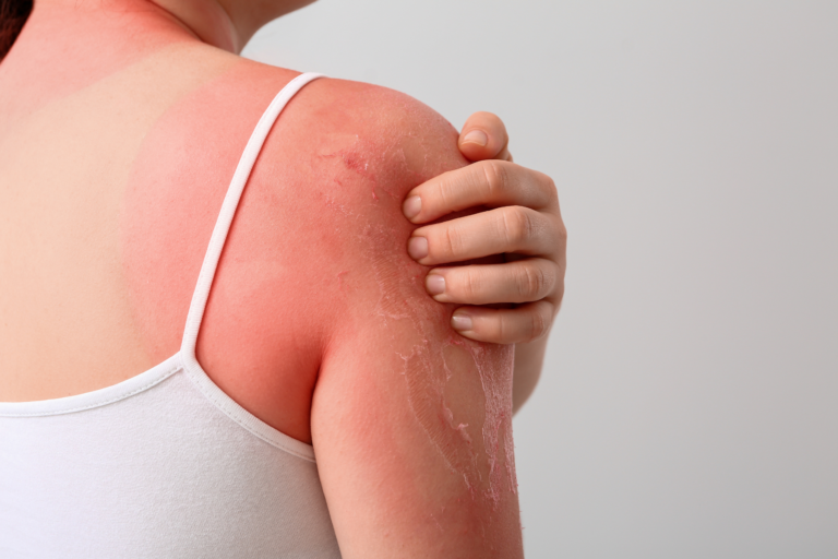 Fotoprotezione dall’interno: il ruolo di nutraceutici e fitoterapici nel danno da UV