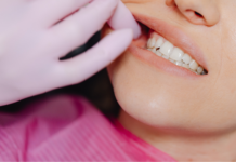 Gli insoliti sospetti dell’erosione dentale Gli insoliti sospetti dell’erosione dentale