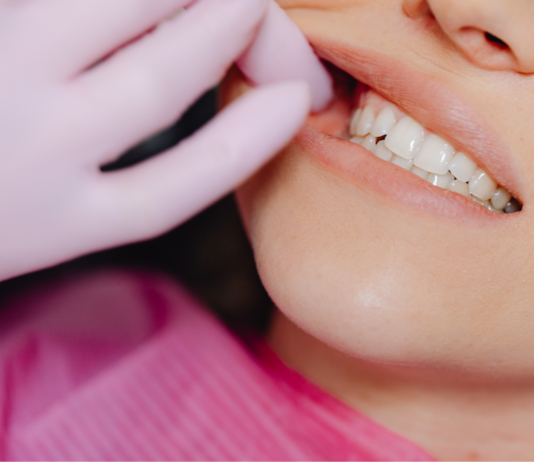 Gli insoliti sospetti dell’erosione dentale Gli insoliti sospetti dell’erosione dentale