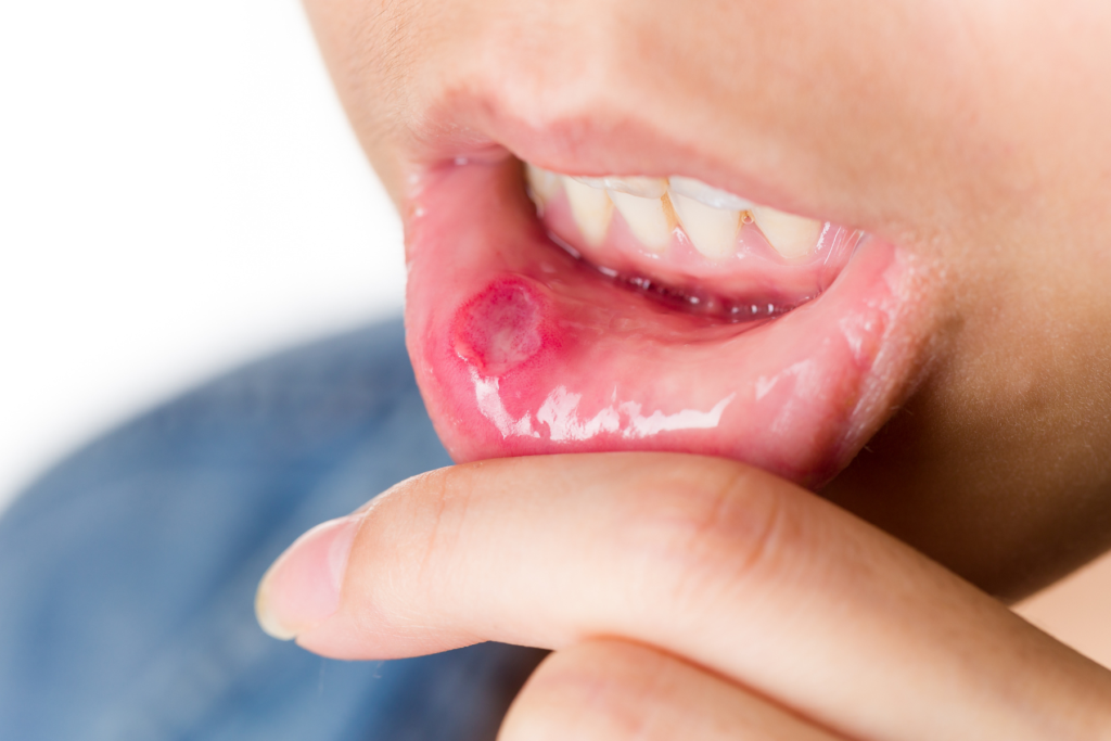 Nella formazione delle afte, la predisposizione individuale e la risposta immunitaria interagirebbero con diversi fattori come stress, microtraumi della mucosa, fattori nutrizionali e alcune condizioni sistemiche.