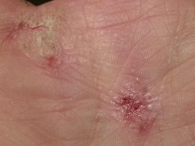 Upadacitinib, ok dall’Ema per la dermatite atopica da moderata a severa