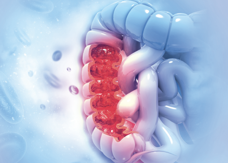 Possibile correlazione tra uso di antibiotici e cancro al colon-retto