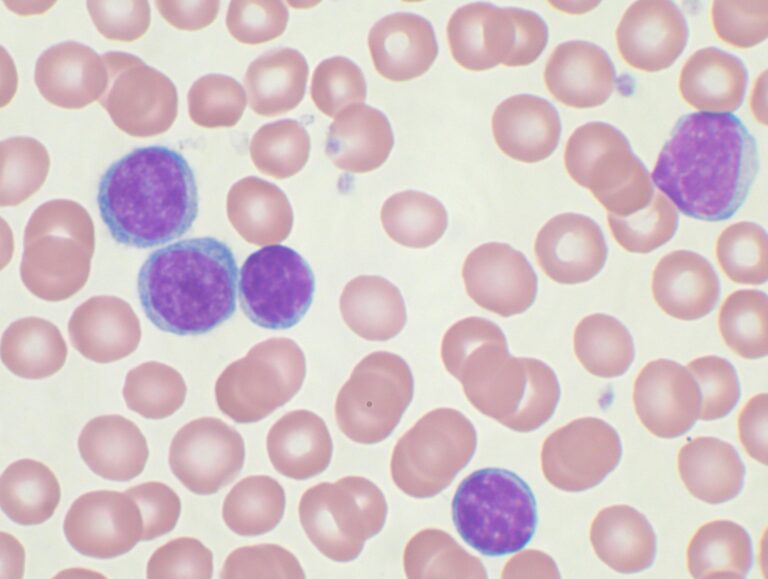 Leucemia linfatica cronica, rimborsabilità di venetoclax in terapia combinata con obinutuzumab