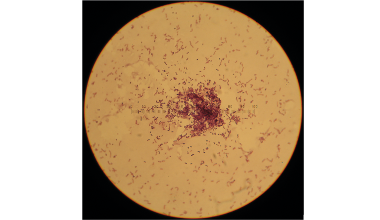 Batteri modificati aiutano a guarire le ulcere diabetiche
