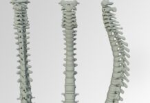 Lesioni spinali, verso il recupero motorio grazie alla medicina rigenerativa