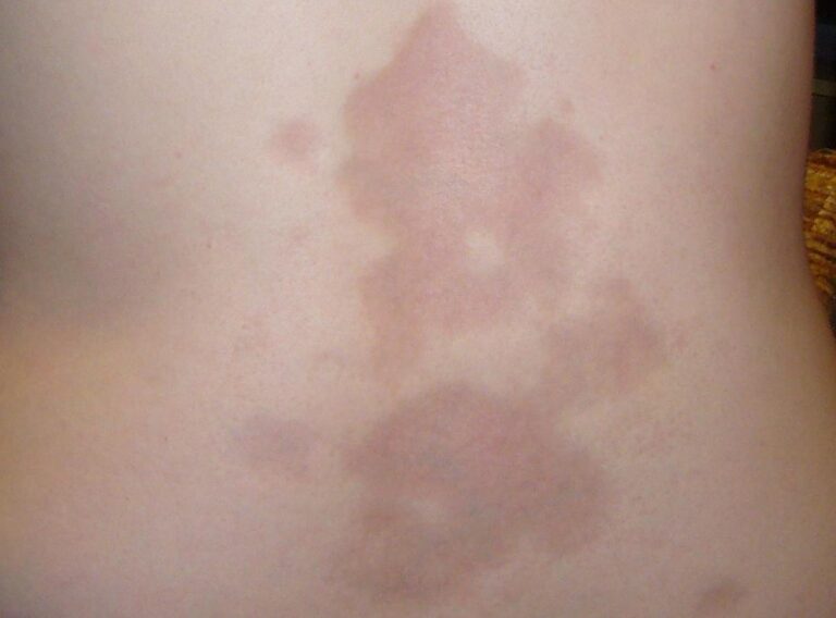 Sclerosi sistemica e medicina di precisione