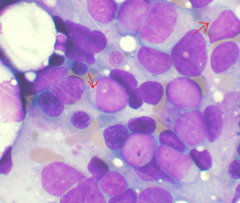 Leucemia mieloide acuta, nuova proposta terapeutica dalla Svezia