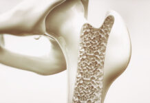 Osteoporosi, accordo su rimborsabilità di romosozumab