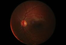 Retinite pigmentosa: identificato gene responsabile