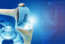 Anestesia multimodale durante artroplastica di ginocchio