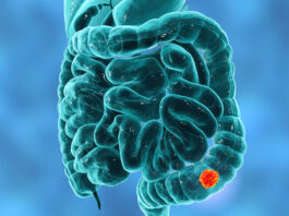 Biopsia liquida nel tumore del colon-retto metastatico e ritrattamento con farmaci anti-Egfr