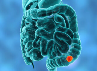 Biopsia liquida nel tumore del colon-retto metastatico e ritrattamento con farmaci anti-Egfr