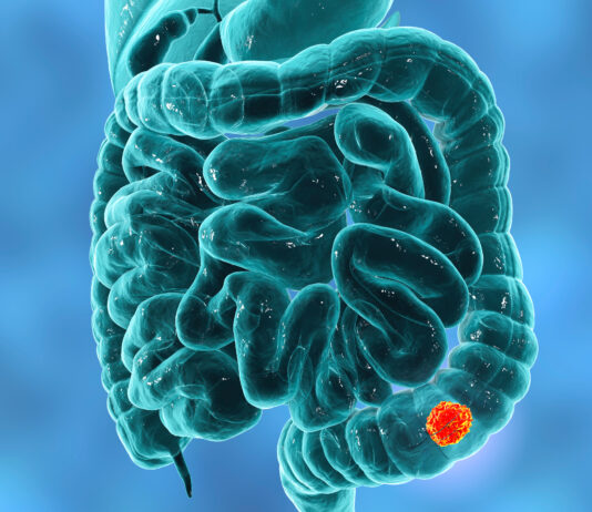 Biopsia liquida nel tumore del colon-retto metastatico e ritrattamento con farmaci anti-Egfr