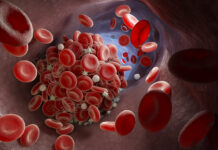 Mielodisplasie, raggiunta tappa cruciale per le cure di precisione