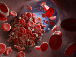 Mielodisplasie, raggiunta tappa cruciale per le cure di precisione