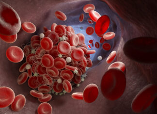 Mielodisplasie, raggiunta tappa cruciale per le cure di precisione