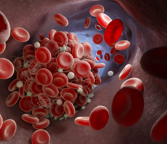 Mielodisplasie, raggiunta tappa cruciale per le cure di precisione