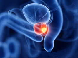 Tumore della prostata: radioterapia stereotassica associata a farmaci riduce del 45% il rischio di morte