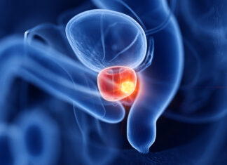 Tumore della prostata: radioterapia stereotassica associata a farmaci riduce del 45% il rischio di morte