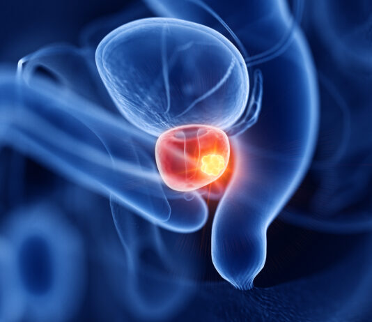 Tumore della prostata: radioterapia stereotassica associata a farmaci riduce del 45% il rischio di morte
