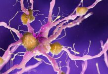 Alzheimer: nanoparticelle d’oro per veicolare il litio nel cervello