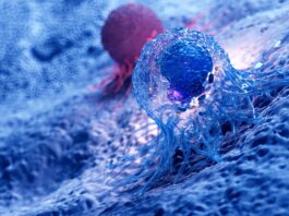 Tumore del retto: grazie al protocollo No-Cut la remissione è possibile senza chirurgia