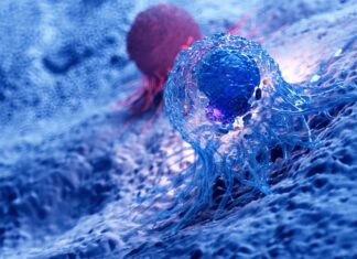 Tumore del retto: grazie al protocollo No-Cut la remissione è possibile senza chirurgia