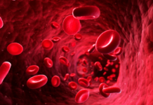 Anemia falciforme e rischio di ictus: i vantaggi della terapia genica