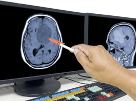 Glioblastoma, premiato progetto dell’Università di Padova