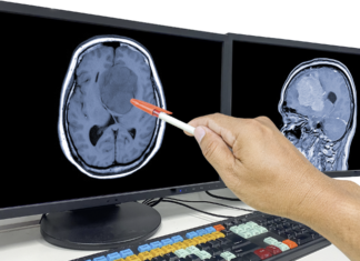 Un nuovo bersaglio terapeutico per il trattamento di glioblastoma e ipossia