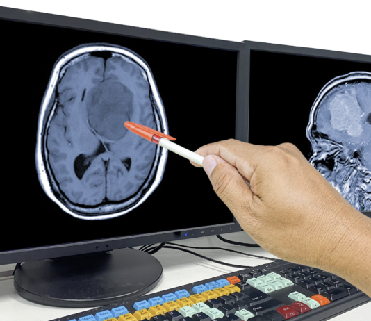 Glioblastoma, premiato progetto dell’Università di Padova