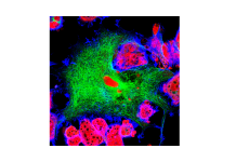 CAR-T GD2 nel neuroblastoma pediatrico recidivato: al via studio multicentrico europeo