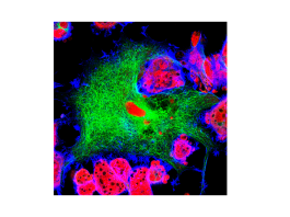 CAR-T GD2 nel neuroblastoma pediatrico recidivato: al via studio multicentrico europeo