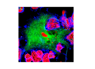 CAR-T GD2 nel neuroblastoma pediatrico recidivato: al via studio multicentrico europeo