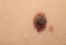 Efficacia dell’immunoterapia nel melanoma ad alto rischio