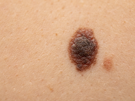Efficacia dell’immunoterapia nel melanoma ad alto rischio
