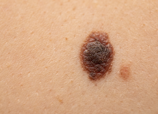 Efficacia dell’immunoterapia nel melanoma ad alto rischio