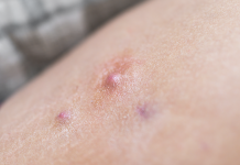 Idrosadenite suppurativa: un problema interdisciplinare in dermatologia, ginecologia e chirurgia