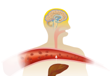 Encefalopatia epatica, evidenze dalla real clinical practice in Italia