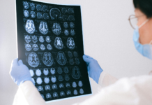 Emorragia cerebrale, il neuroimaging guida le decisioni cliniche Neuroimaging nell'emorragia cerebrale