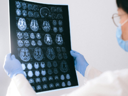 Emorragia cerebrale, il neuroimaging guida le decisioni cliniche Neuroimaging nell'emorragia cerebrale