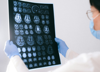 Emorragia cerebrale, il neuroimaging guida le decisioni cliniche Neuroimaging nell'emorragia cerebrale