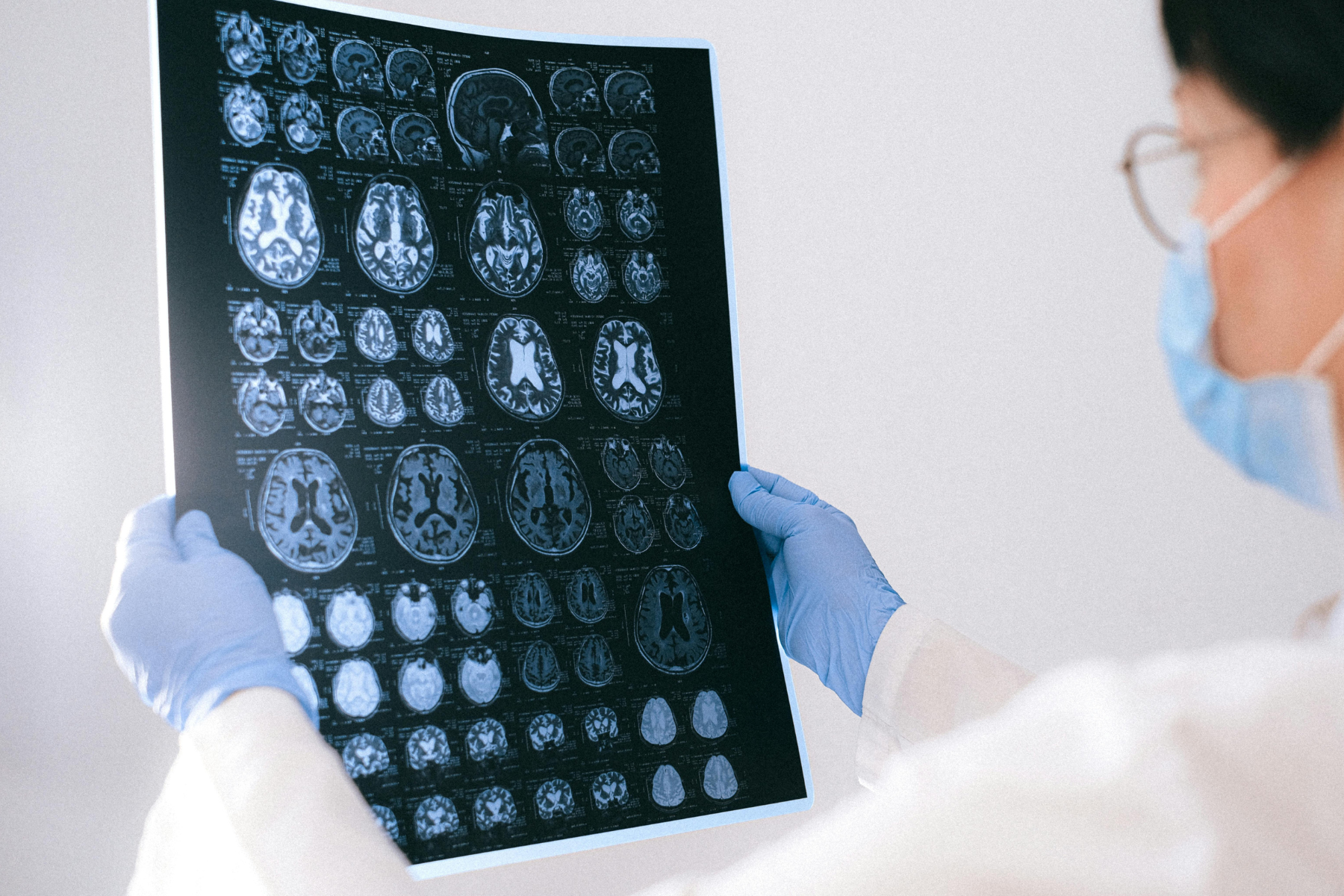 Emorragia cerebrale, il neuroimaging guida le decisioni cliniche