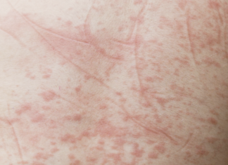 Teleangectasia emorragica ereditaria, rara ma non troppo: risultati di una nuova ricerca Teleangectasia emorragica ereditaria