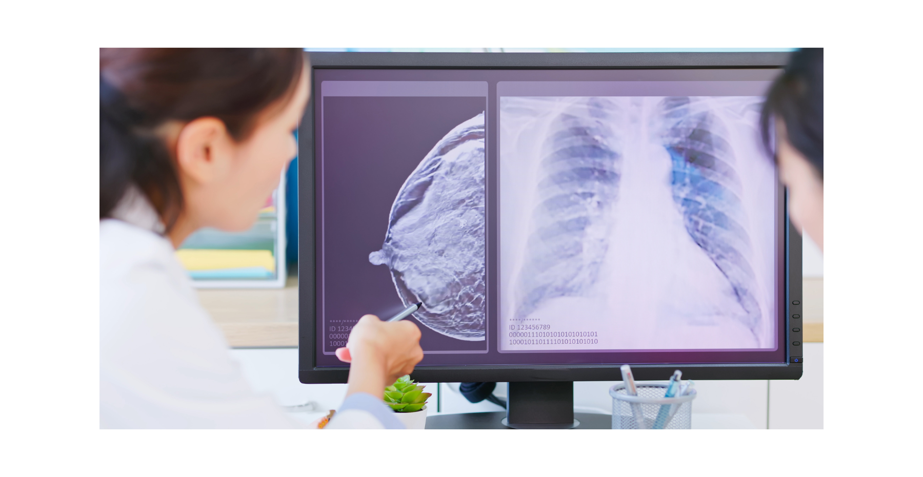 Tumore al seno in pre-menopausa: prolungare la terapia ormonale riduce recidive e metastasi